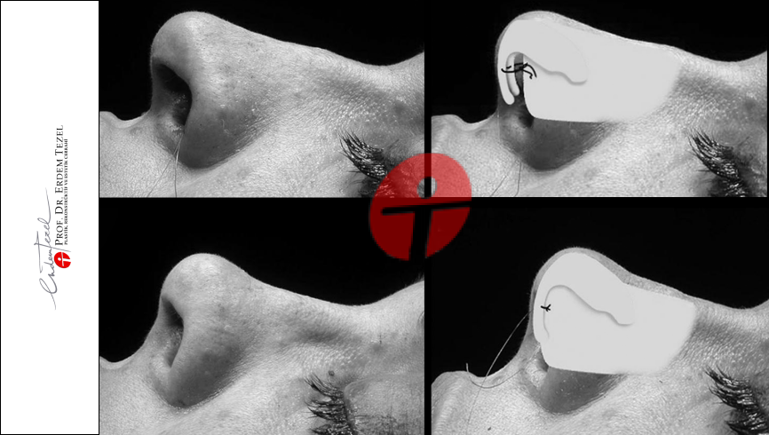 Scarless Cartilage Fixation Method Septocolumellar Suture in Closed Rhinoplasty